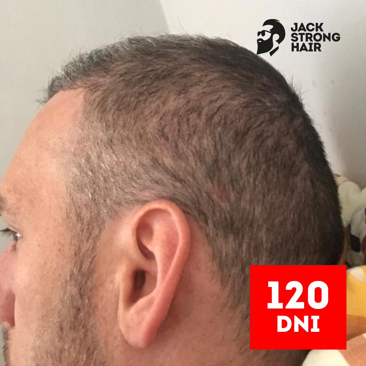 zdjęcie efektu zabiegu przeszczepu włosów po 120 dniach