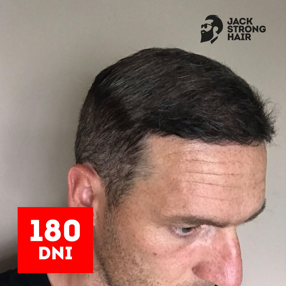 zdjęcie efektu przeszczepu włosów po 180 dniach