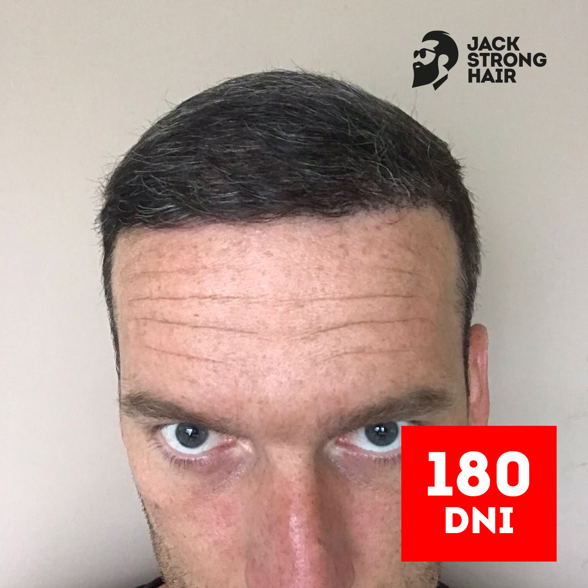 zdjęcie efektu przeszczepu włosów po 180 dniach