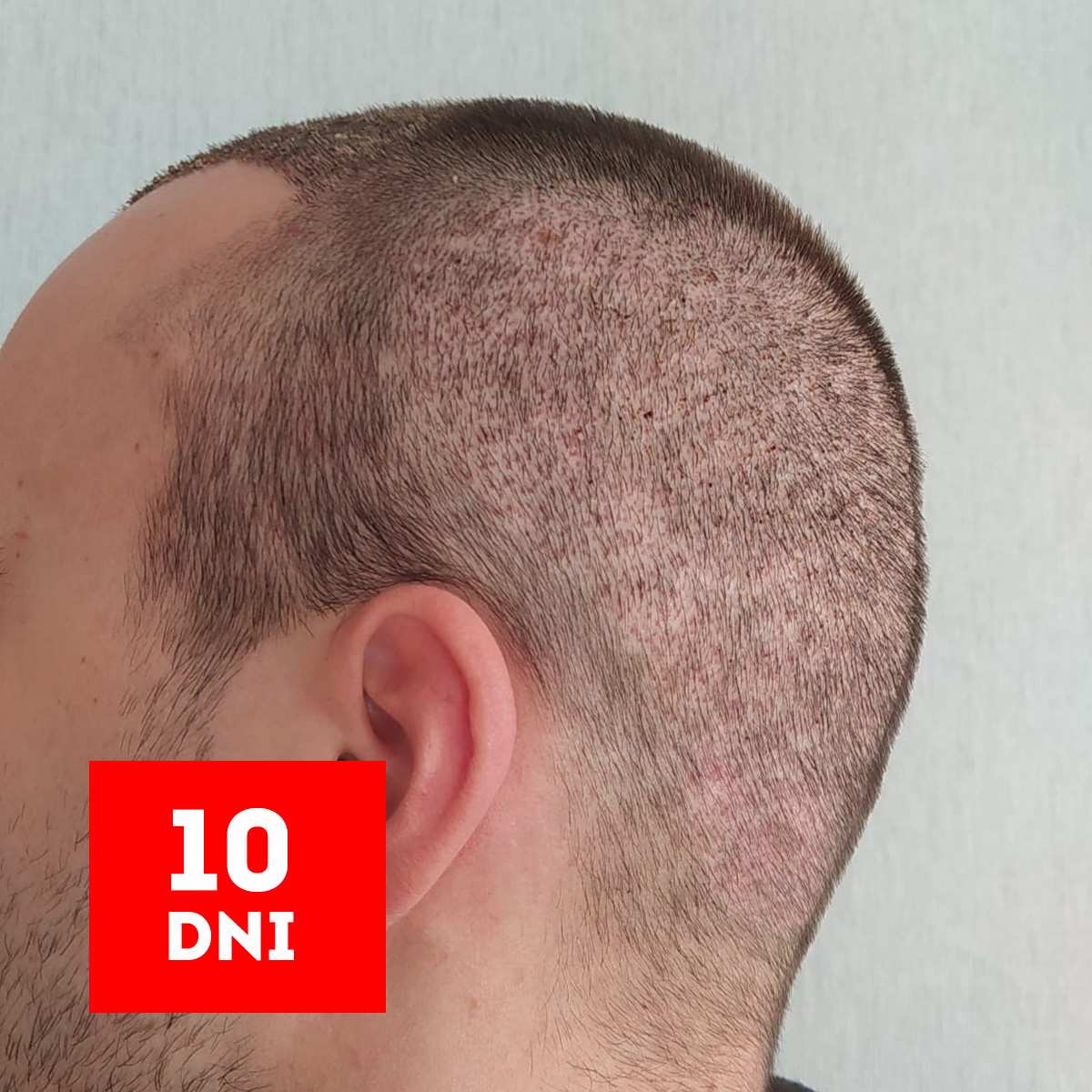 rezultaty 10 dni po przeszczepie włosów