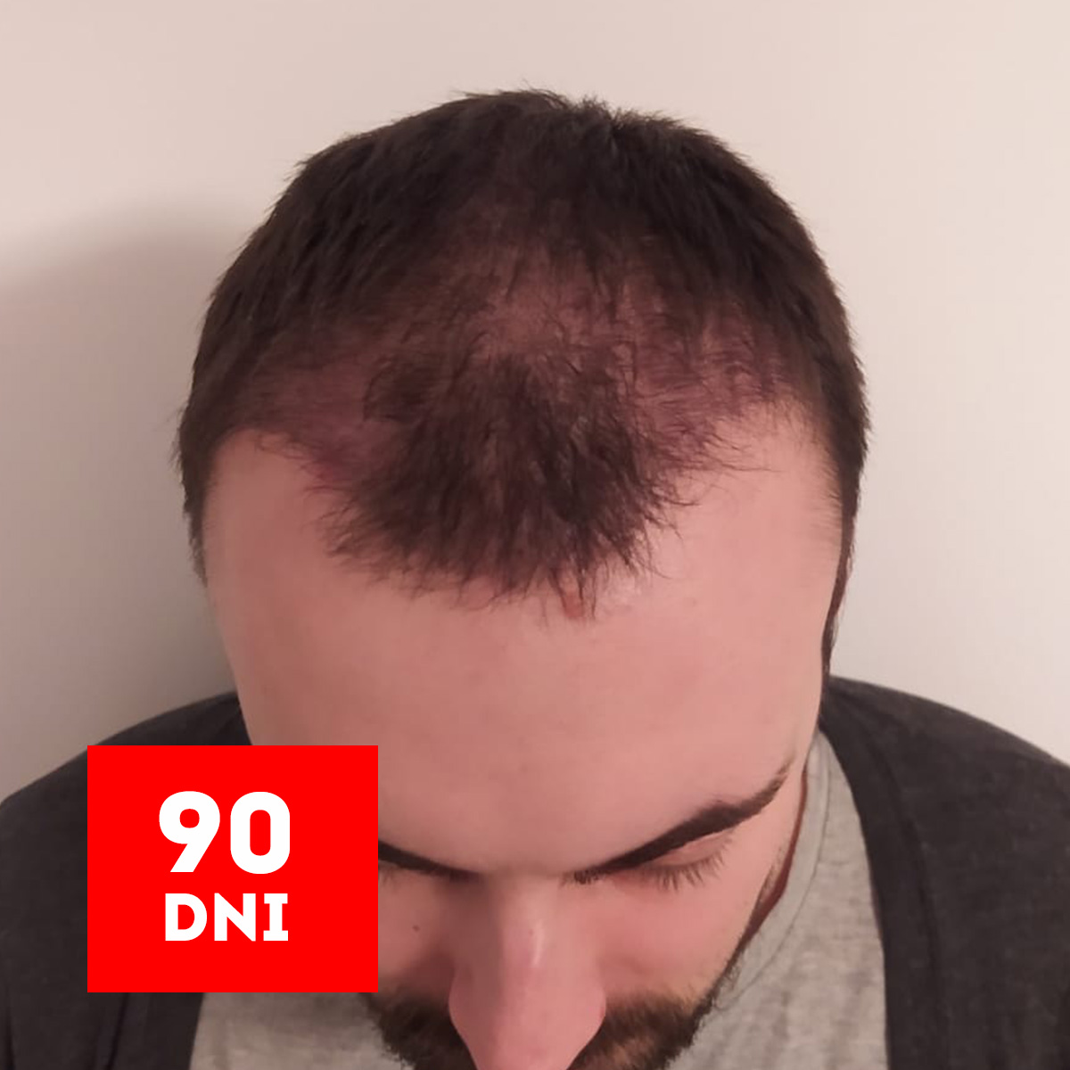 efekt 90 dni po przeszczepie włosów