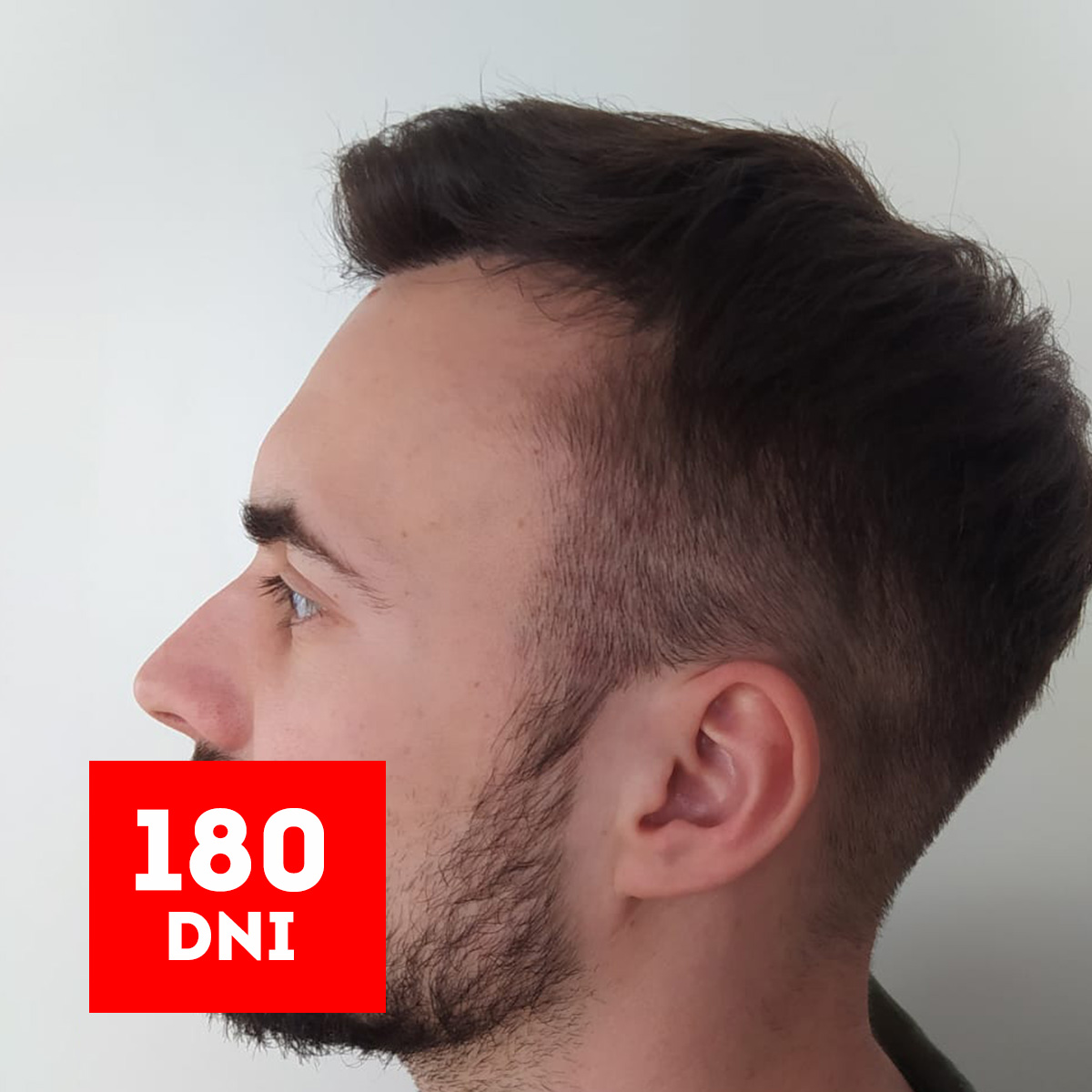 efekt 180 dni po przeszczepie włosów