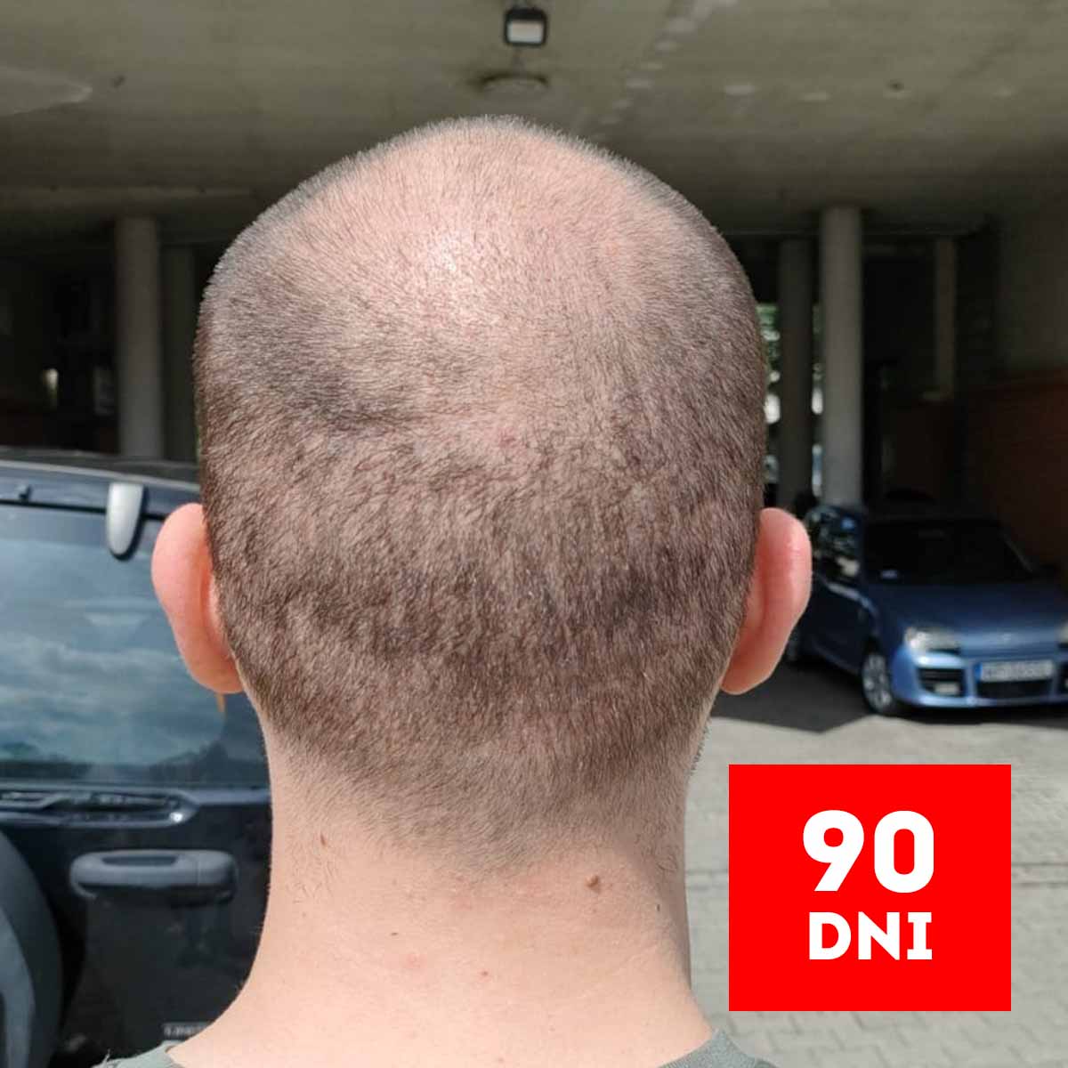 efekt 90 dni po przeszczepie włosów