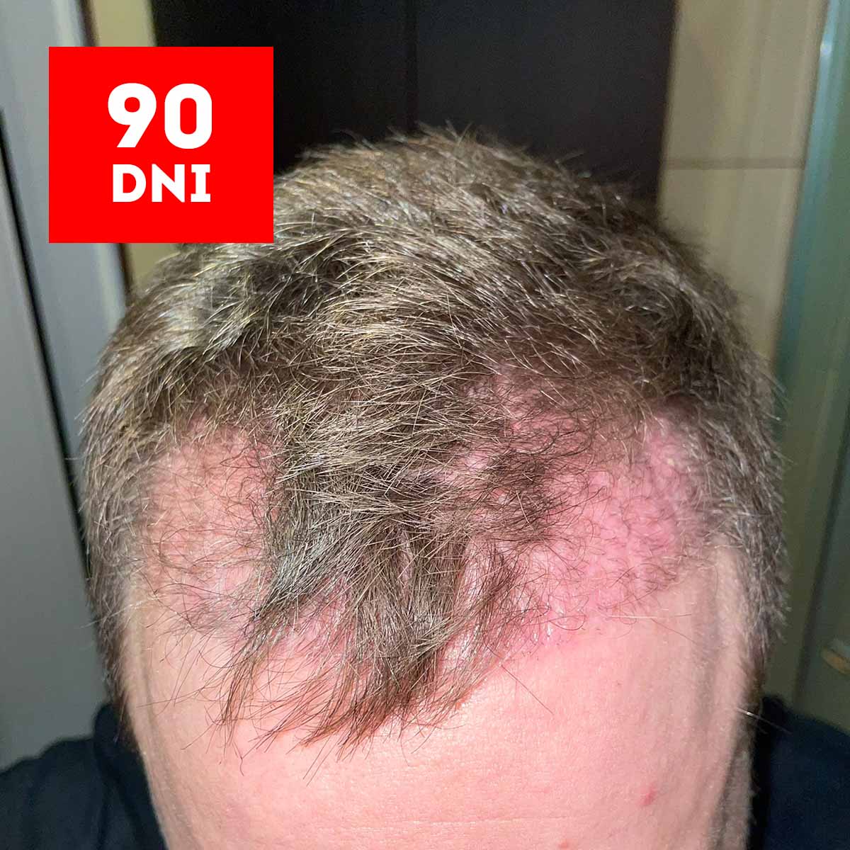 90 dzień po przeszczepie włosów