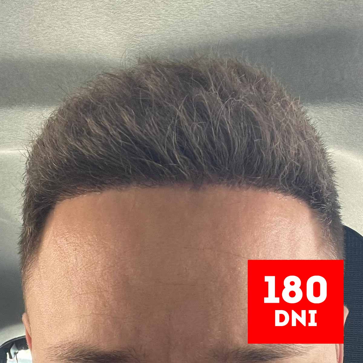 180 dni po przeszczepie włosów efekt